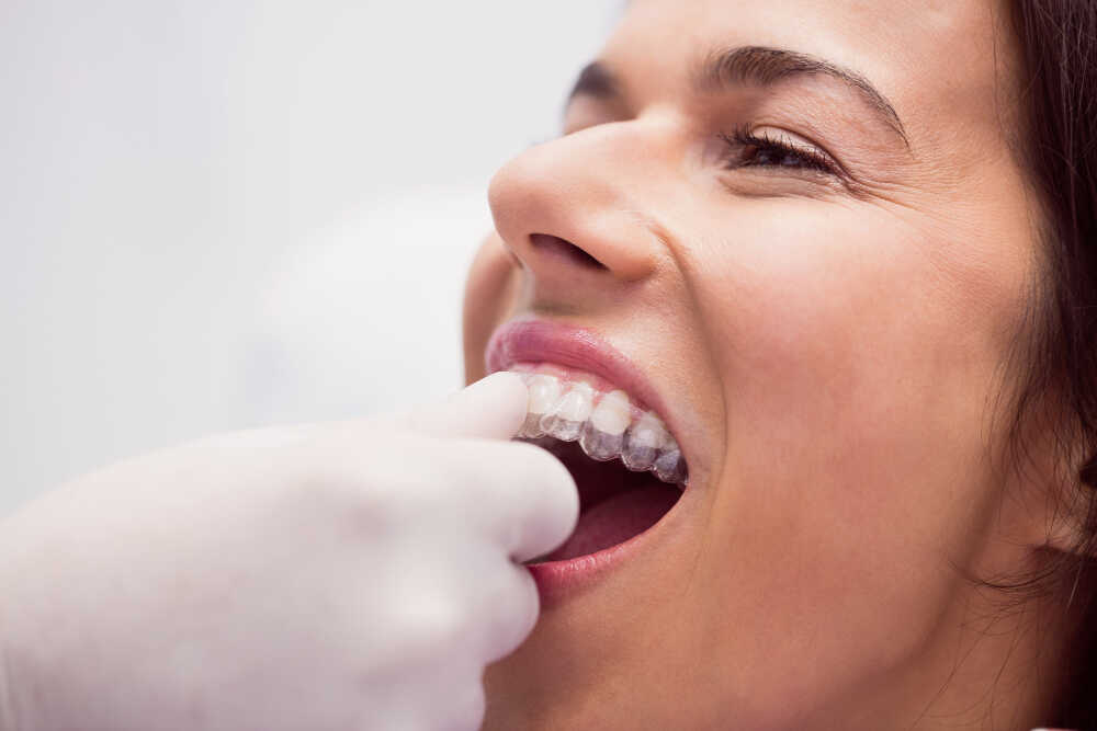 dentysta zakłada kobiecie aparat estetyczny w formie nakładek