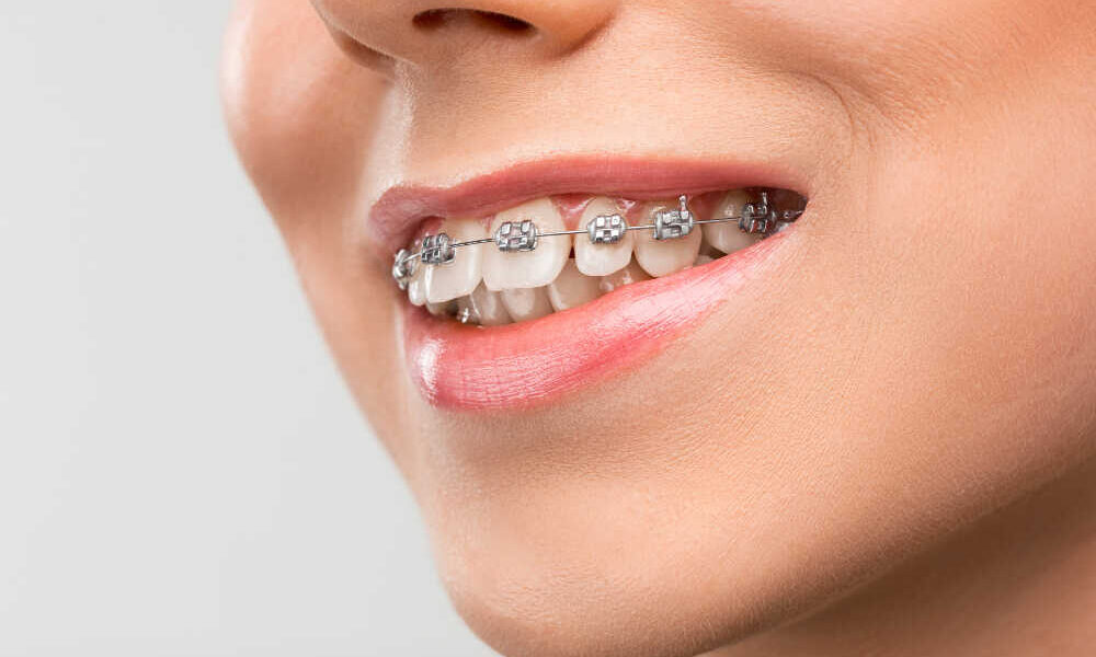 Aparat ortodontyczny vs nakładki na zęby - co wybrać?