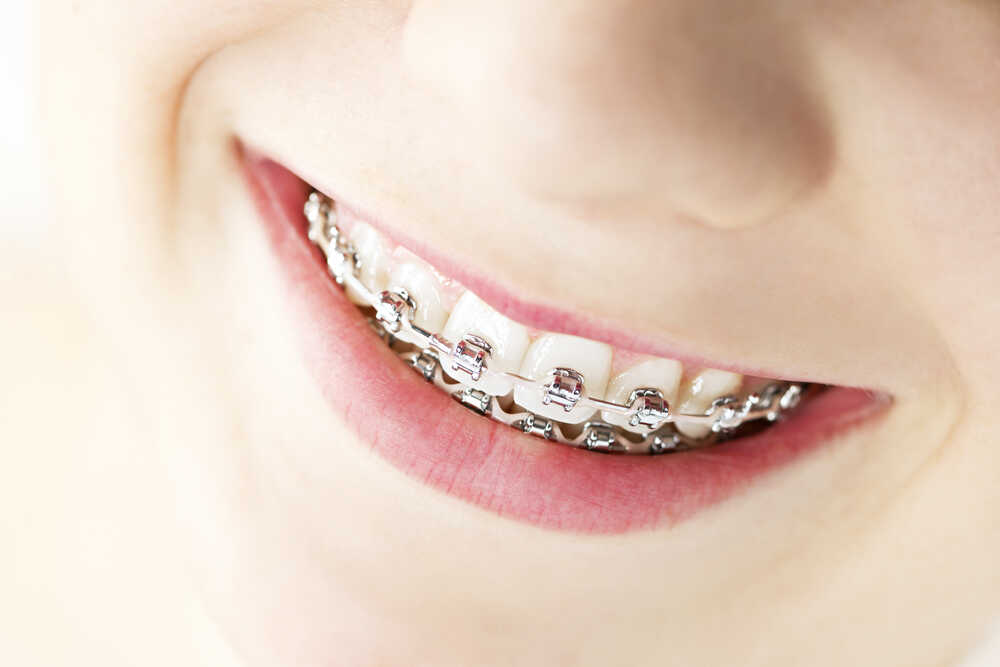 Jakie są objawy uczulenia na aparat ortodontyczny?