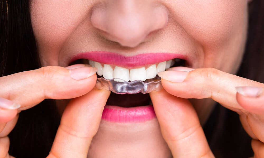 Aparat ortodontyczny stały - co warto wiedzieć przed założeniem?